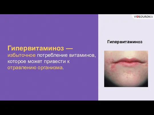 Гипервитаминоз — избыточное потребление витаминов, которое может привести к отравлению организма. Гипервитаминоз