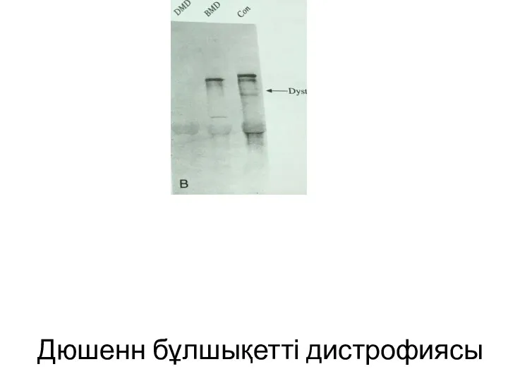 Дюшенн бұлшықетті дистрофиясы