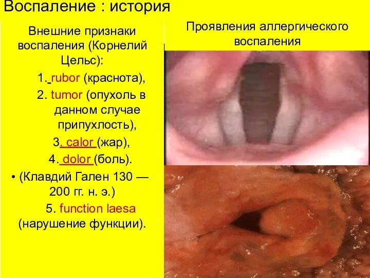 Воспаление : история Внешние признаки воспаления (Корнелий Цельс): 1. rubor (краснота), 2.