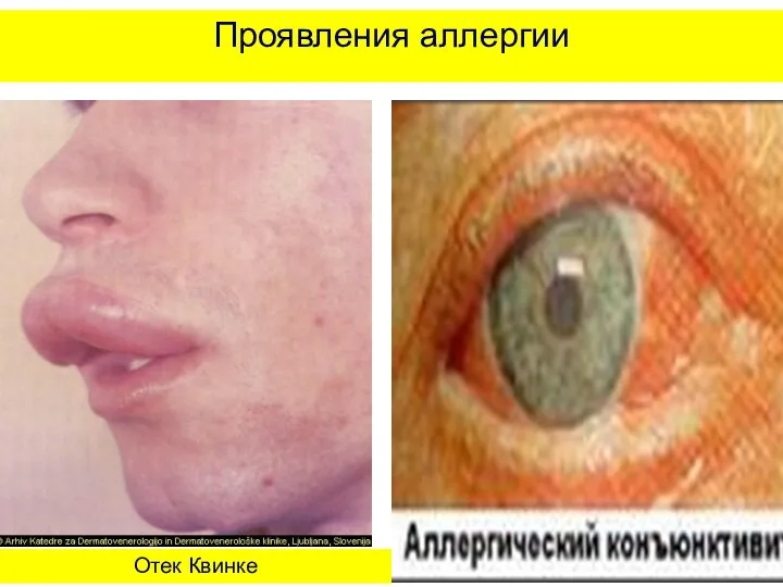 Проявления аллергии Отек Квинке