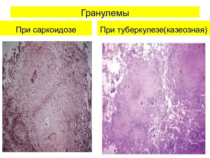 Гранулемы При саркоидозе При туберкулезе(казеозная)