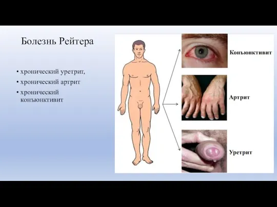 Болезнь Рейтера хронический уретрит, хронический артрит хронический конъюнктивит