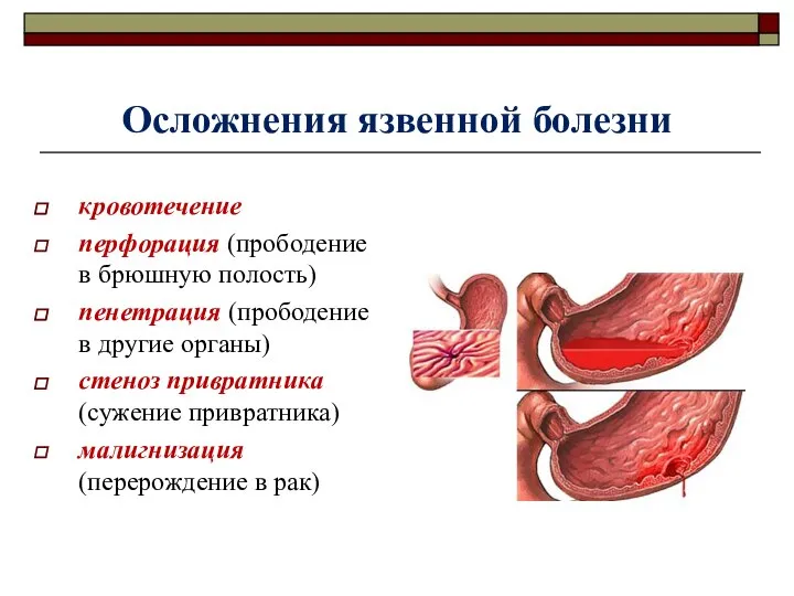 Осложнения язвенной болезни кровотечение перфорация (прободение в брюшную полость) пенетрация (прободение в