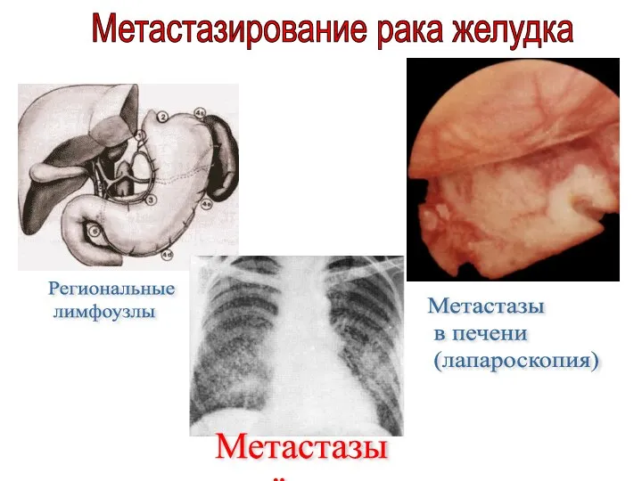 Метастазирование рака желудка Региональные лимфоузлы Метастазы в печени (лапароскопия) Метастазы в лёгких
