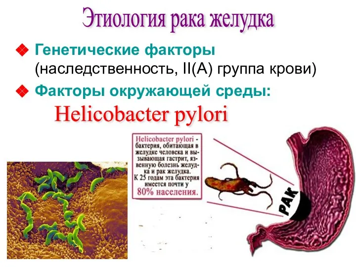Этиология рака желудка Генетические факторы (наследственность, II(А) группа крови) Факторы окружающей среды: Helicobacter pylori