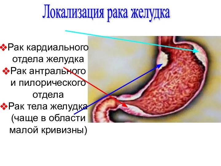 Локализация рака желудка Рак кардиального отдела желудка Рак антрального и пилорического отдела