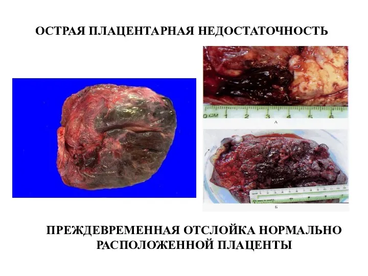 ОСТРАЯ ПЛАЦЕНТАРНАЯ НЕДОСТАТОЧНОСТЬ ПРЕЖДЕВРЕМЕННАЯ ОТСЛОЙКА НОРМАЛЬНО РАСПОЛОЖЕННОЙ ПЛАЦЕНТЫ