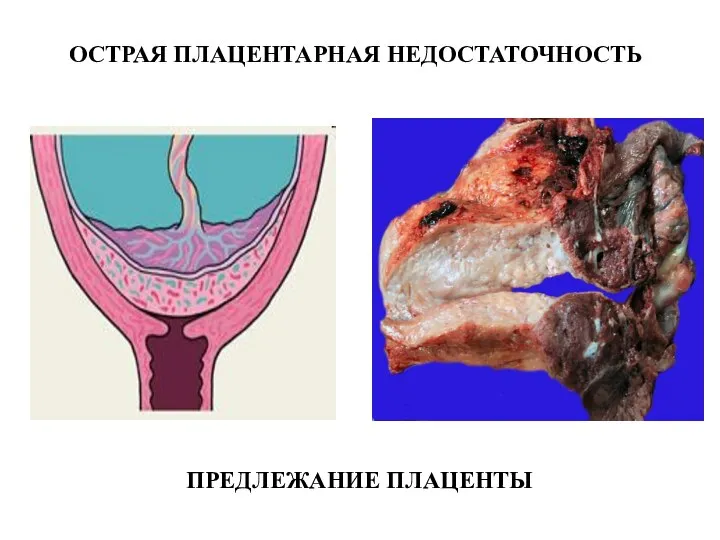 ОСТРАЯ ПЛАЦЕНТАРНАЯ НЕДОСТАТОЧНОСТЬ ПРЕДЛЕЖАНИЕ ПЛАЦЕНТЫ