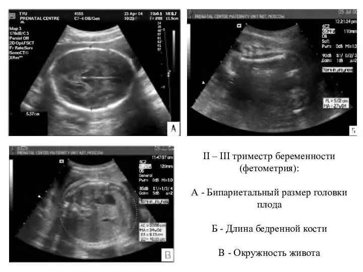 II – III триместр беременности (фетометрия): А - Бипариетальный размер головки плода