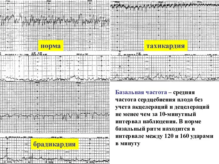 Базальная частота – средняя частота сердцебиения плода без учета акцелераций и децелераций