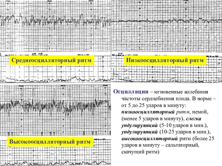 Осцилляции – мгновенные колебания частоты сердцебиения плода. В норме – от 5