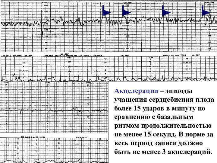 Акцелерации – эпизоды учащения сердцебиения плода более 15 ударов в минуту по