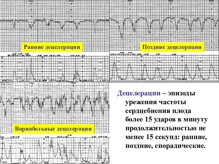 Децелерации – эпизоды урежения частоты сердцебиения плода более 15 ударов в минуту