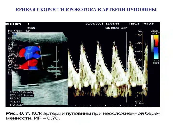 КРИВАЯ СКОРОСТИ КРОВОТОКА В АРТЕРИИ ПУПОВИНЫ