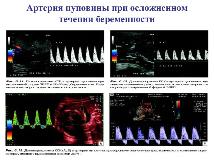 Артерия пуповины при осложненном течении беременности