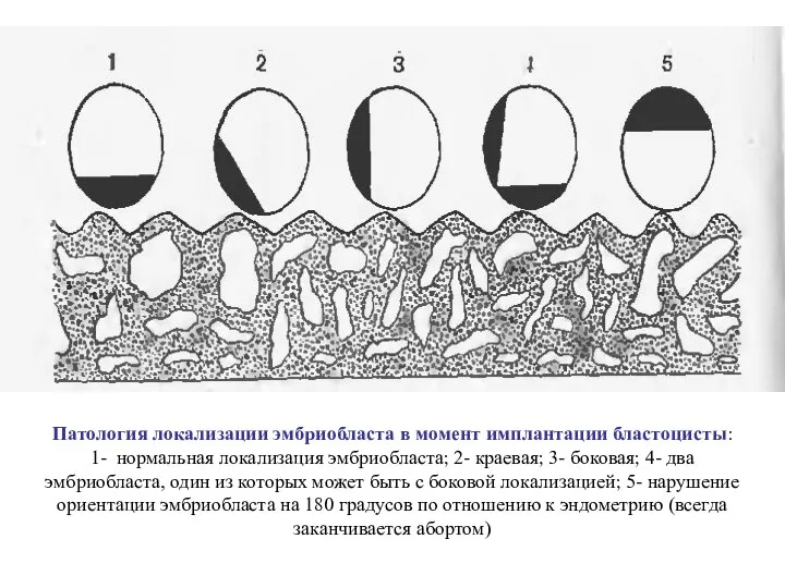 Патология локализации эмбриобласта в момент имплантации бластоцисты: 1- нормальная локализация эмбриобласта; 2-