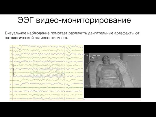 ЭЭГ видео-мониторирование Визуальное наблюдение помогает различить двигательные артефакты от патологической активности мозга.