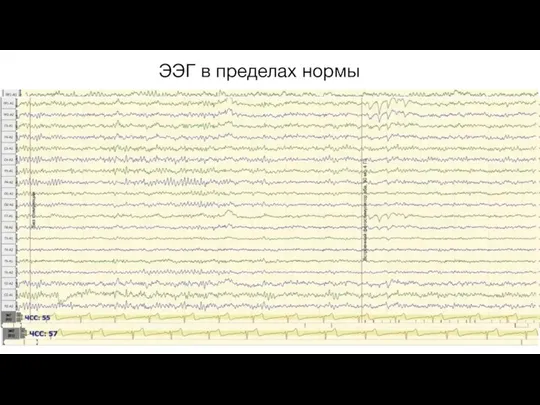 ЭЭГ в пределах нормы