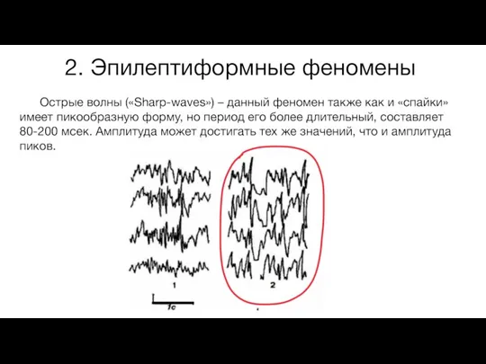 2. Эпилептиформные феномены Острые волны («Sharp-waves») – данный феномен также как и