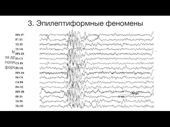 3. Эпилептиформные феномены Множественные пики, полипики, «полиспайки» - группа следующих друг за