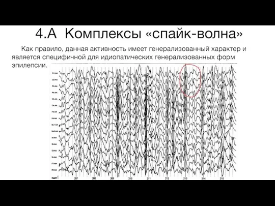 4.А Комплексы «спайк-волна» Как правило, данная активность имеет генерализованный характер и является