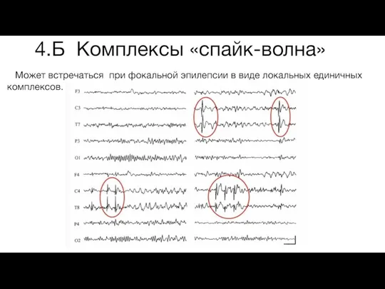 4.Б Комплексы «спайк-волна» Может встречаться при фокальной эпилепсии в виде локальных единичных комплексов.