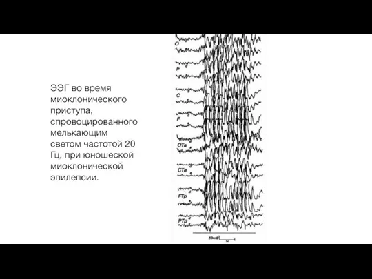 ЭЭГ во время миоклонического приступа, спровоцированного мелькающим светом частотой 20 Гц, при юношеской миоклонической эпилепсии.