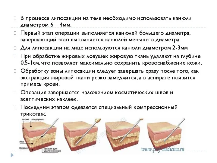 В процессе липосакции на теле необходимо использовать канюли диаметром 6 – 4мм.