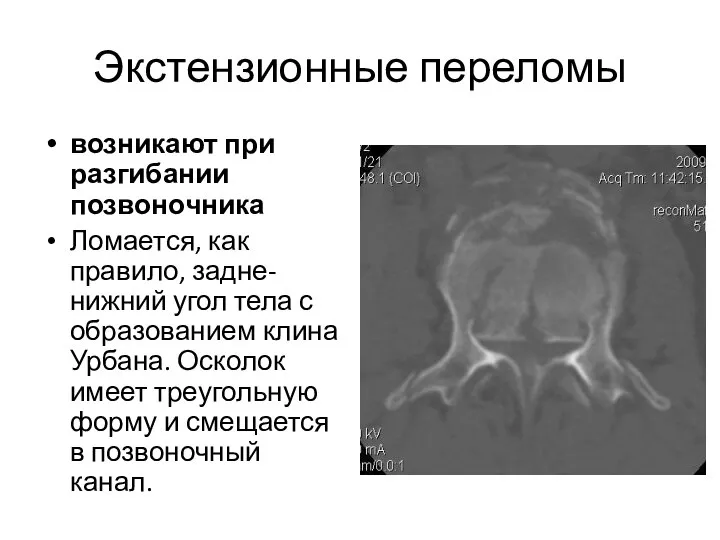 Экстензионные переломы возникают при разгибании позвоночника Ломается, как правило, задне-нижний угол тела