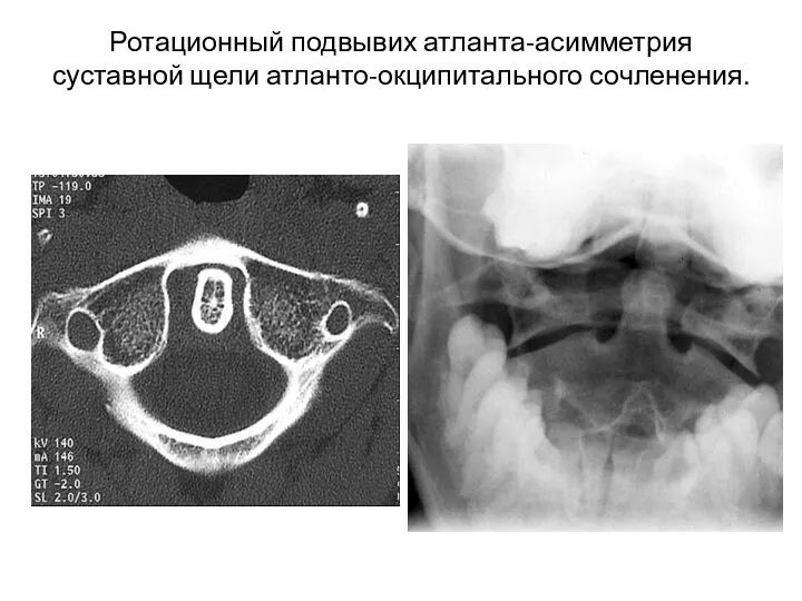 Ротационный подвывих атланта-асимметрия суставной щели атланто-окципитального сочленения.