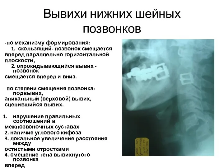 Вывихи нижних шейных позвонков -по механизму формирования: 1. скользящий- позвонок смещается вперед