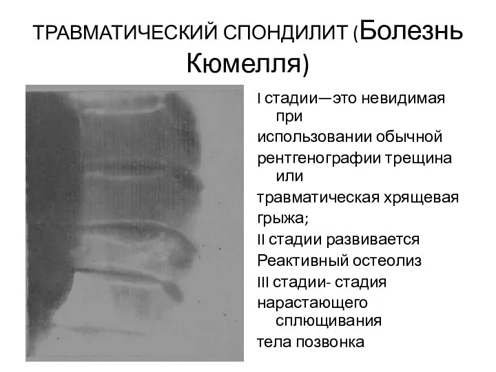 ТРАВМАТИЧЕСКИЙ СПОНДИЛИТ (Болезнь Кюмелля) I стадии—это невидимая при использовании обычной рентгенографии трещина