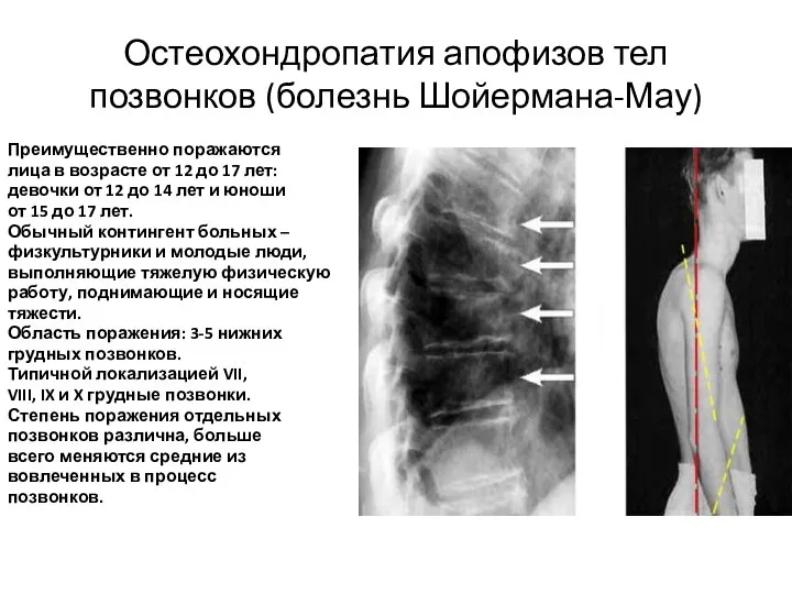 Остеохондропатия апофизов тел позвонков (болезнь Шойермана-Мау) Преимущественно поражаются лица в возрасте от