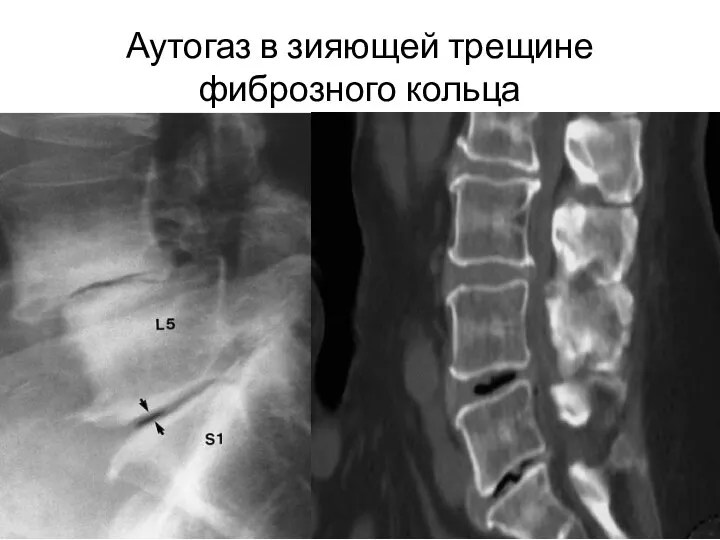 Аутогаз в зияющей трещине фиброзного кольца