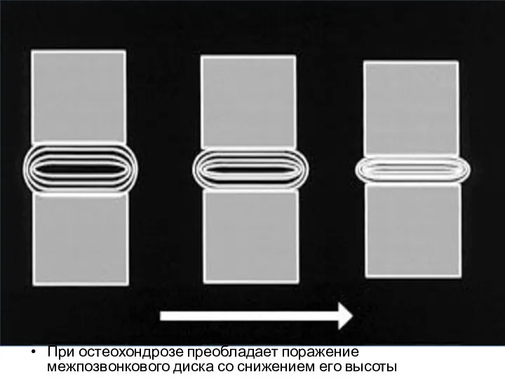 При остеохондрозе преобладает поражение межпозвонкового диска со снижением его высоты