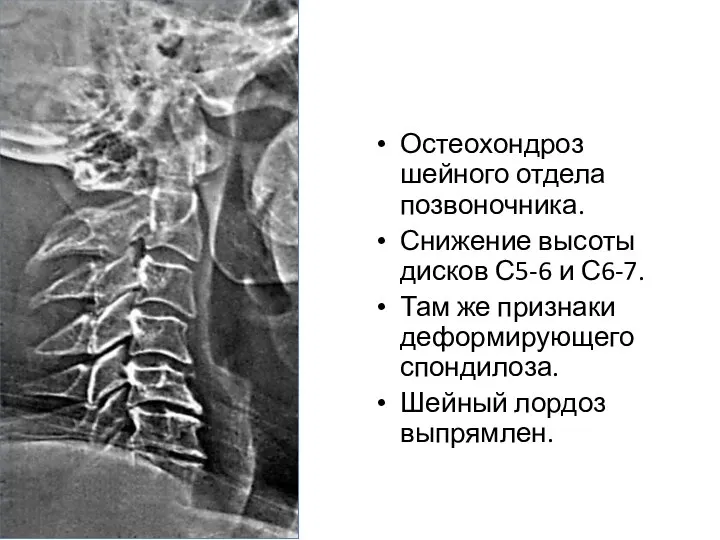 Остеохондроз шейного отдела позвоночника. Снижение высоты дисков С5-6 и С6-7. Там же