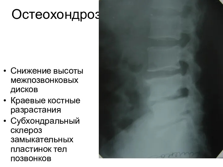 Остеохондроз Снижение высоты межпозвонковых дисков Краевые костные разрастания Субхондральный склероз замыкательных пластинок тел позвонков