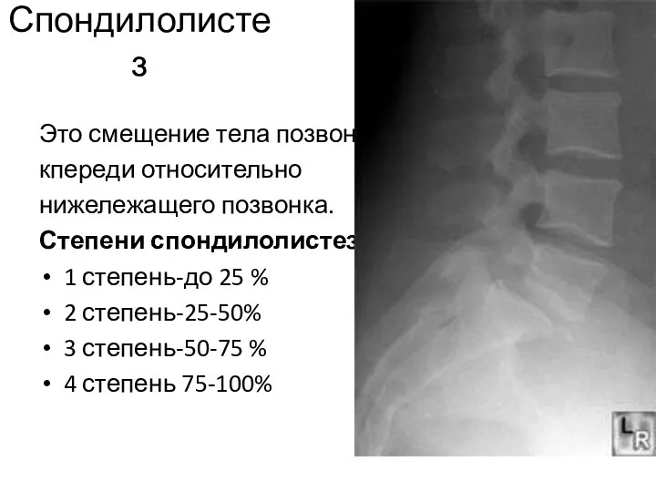 Спондилолистез Это смещение тела позвонка кпереди относительно нижележащего позвонка. Степени спондилолистеза 1