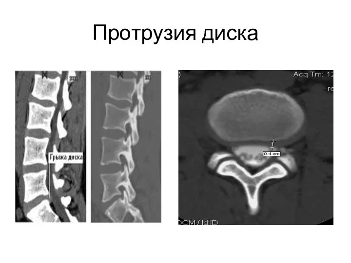 Протрузия диска