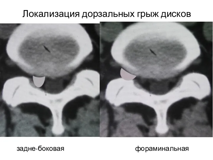 Локализация дорзальных грыж дисков задне-боковая фораминальная