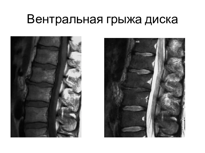 Вентральная грыжа диска