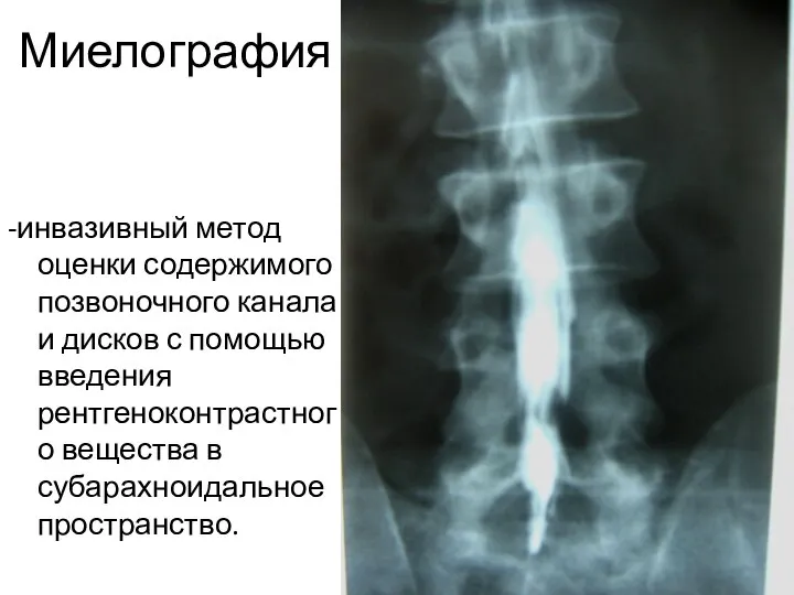 Миелография -инвазивный метод оценки содержимого позвоночного канала и дисков с помощью введения