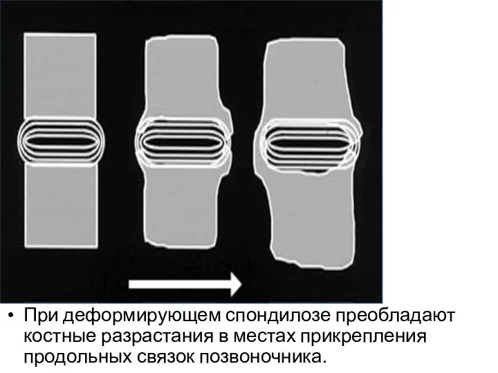 При деформирующем спондилозе преобладают костные разрастания в местах прикрепления продольных связок позвоночника.