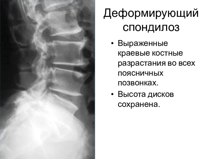 Деформирующий спондилоз Выраженные краевые костные разрастания во всех поясничных позвонках. Высота дисков сохранена.