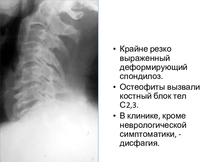 Крайне резко выраженный деформирующий спондилоз. Остеофиты вызвали костный блок тел С2,3. В