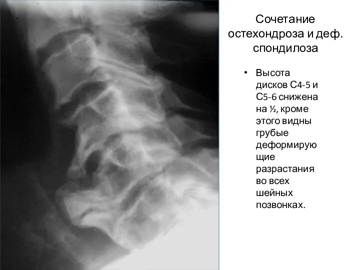 Сочетание остехондроза и деф. спондилоза Высота дисков С4-5 и С5-6 снижена на