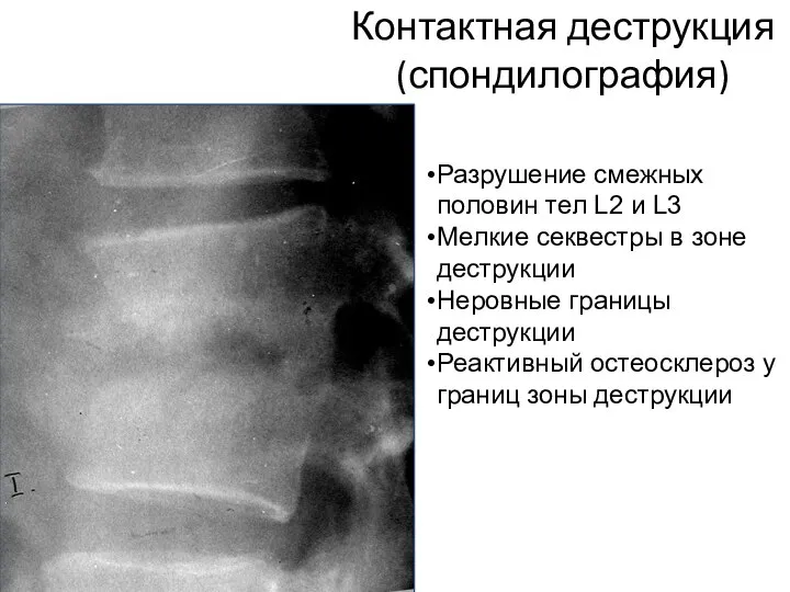 Контактная деструкция (спондилография) Разрушение смежных половин тел L2 и L3 Мелкие секвестры