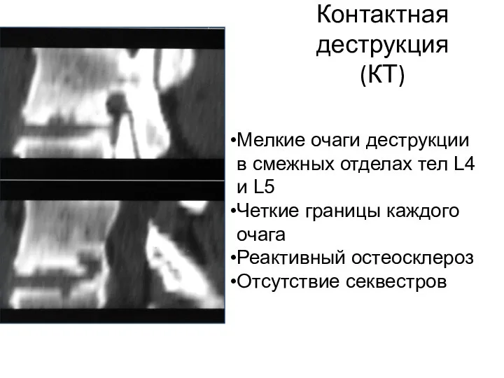 Контактная деструкция (КТ) Мелкие очаги деструкции в смежных отделах тел L4 и