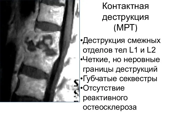 Контактная деструкция (МРТ) Деструкция смежных отделов тел L1 и L2 Четкие, но