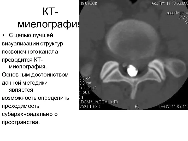 КТ-миелография С целью лучшей визуализации структур позвоночного канала проводится КТ-миелография. Основным достоинством